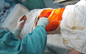 HY HỮU: Bác sỹ để quên kéo trong bụng bệnh nhân 18 năm