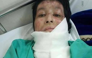 Vợ đăng ảnh facebook, chồng ghen tạt xăng đốt trong bếp