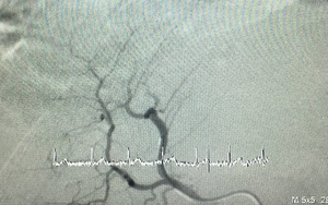 Cứu sống bệnh nhân vỡ u gan hy hữu