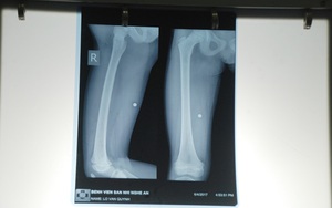 Bệnh nhi 8 tuổi đứt dây thần kinh, teo chân do bác sĩ để sót dị vật