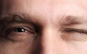 Tưởng nháy mắt trái là điềm lành, nam doanh nhân phải nhập viện vì liệt nửa mặt