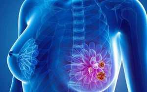 Việt Nam mỗi năm có 22.000 ca mắc mới và hơn 9.000 ca tử vong vì ung thư vú: BS Bệnh viện K cảnh báo người dân vẫn coi thường căn bệnh nguy hiểm này