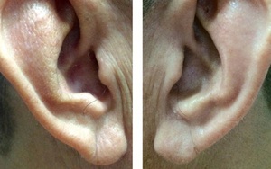 Nghiên cứu 500 tử thi, phát hiện 80% người bệnh tim đều có dấu vết lạ ở tai: Soi gương nếu thấy nếp gấp này cần hết sức thận trọng