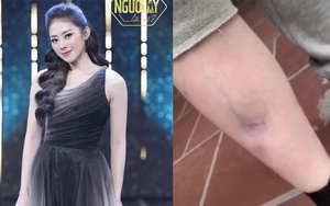 Hot girl 'Người ấy là ai' bị teo cơ, giãn tĩnh mạch do tiêm xóa thâm sai cách giờ ra sao?