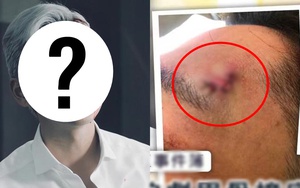 Sau 'nam thần thanh xuân' Kha Chấn Đông, thêm 1 mỹ nam có nguy cơ bị 'hủy dung' vì tai nạn phim trường nghiêm trọng!