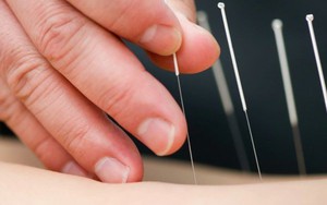 Châm cứu có thể giúp giảm đau trong phẫu thuật ung thư