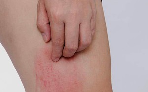 Hai bộ phận trên cơ thể ngứa ngáy là dấu hiệu của bệnh ung thư gan, nhiều người lại lầm tưởng là dị ứng