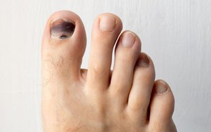 Người gan kém thường gặp 3 vấn đề này ở bàn chân, mong rằng bạn không có dù chỉ là 1 điểm