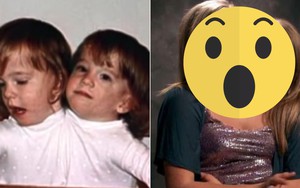 Từng bị chẩn đoán không có khả năng sống do dính liền 90% cơ thể, cặp song sinh nổi tiếng từng khiến thế giới ngỡ ngàng bây giờ ra sao?