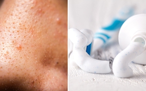 Da mặt tổn thương nghiêm trọng vì dùng kem đánh răng trị mụn theo Tiktok