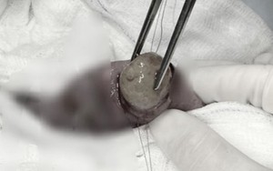 Cảnh báo nguy hiểm khi trẻ nuốt đồ chơi hạt nở​