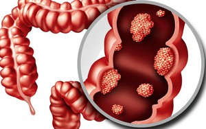 2 dấu hiệu hàng đầu của ung thư đại tràng và những đối tượng dễ mắc 