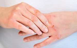 Cơ thể thiếu vitamin B2 có thể dẫn đến 4 tổn thương lớn, đặc biệt có 3 nhóm người nên cảnh giác