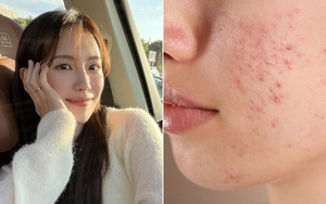 Kem chống nắng cho da dầu mụn: 5 tuýp kem lành tính, giảm mụn sưng viêm, có thể mua ngay ở siêu thị