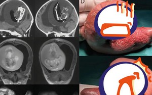 Mang thai đôi nhưng chỉ sinh một bé, 1 năm sau bố mẹ đưa con gái đi khám mới phát hiện sự thật đáng sợ nằm trong não