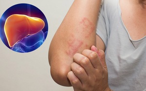 Bị viêm gan B nhưng không đi khám thường xuyên, lúc bệnh nặng mới phát hiện đã bị ung thư