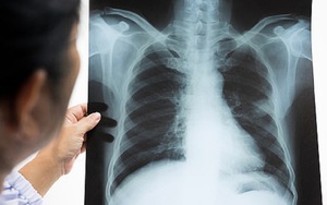 5 bữa sáng có nguy cơ gây ung thư cao: Món đầu nhiều người 'nghiền' nhưng cực độc hại
