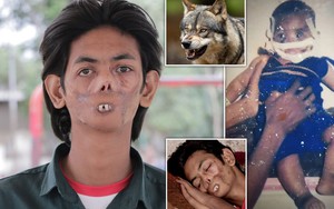 Bị sói tấn công từ khi còn nhỏ, chàng trai 18 tuổi bị dân làng xa lánh, gọi là "cậu bé ma" vì ngoại hình biến dạng khiến nhiều người xót xa