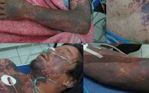 Người đàn ông bị viêm màng não mủ do ăn tiết canh ngan bán ở chợ