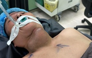 Người phụ nữ bị áp xe tuyến giáp vì tự đắp thuốc nam