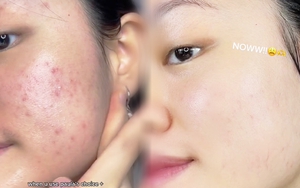 Gái xinh thu về 5 triệu view trên TikTok nhờ hành trình 1 tháng trị mụn với nhiều sản phẩm 'êm ví', có món chưa tới 80K mà thành quả vẫn mê