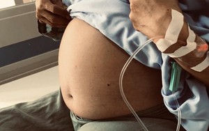 Tưởng béo bụng nên chủ quan không đi khám, cụ bà 'tá hỏa' phát hiện khối u gần 10kg trong người 