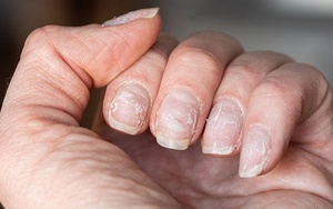 4 thay đổi trên bàn tay ngầm cảnh báo nguy cơ mắc bệnh gan, biết sớm để phòng tránh cũng chưa muộn