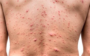 Số ca thủy đậu ở Hà Nội tăng cao, chuyên gia chỉ cách phòng tránh
