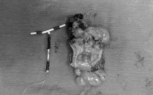 Dụng cụ tránh thai đi lạc chỗ khiến người phụ nữ bị thủng đại tràng