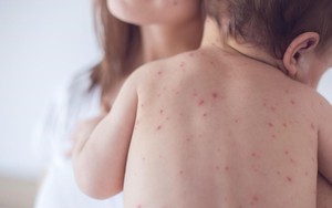 Giao mùa, bệnh viện liên tiếp tiếp nhận các ca mắc thuỷ đậu: Bệnh quen thuộc nhưng biến chứng khôn lường, gây viêm não, động kinh nếu không chữa kịp thời 