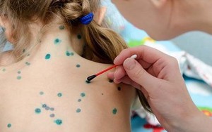 Bệnh thủy đậu bùng phát mạnh tại Hà Nội, sắp chạm ngưỡng 1.000 ca: Làm gì để phòng tránh?