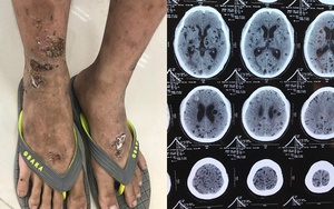 Nhiều người phù não, lở loét vì nhiễm ký sinh trùng: Bác sĩ chỉ cách phòng tránh