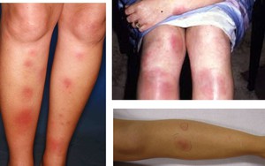 Căn bệnh hay gặp ở các chị em 20-30 tuổi khiến da sẩn cục, nóng đỏ