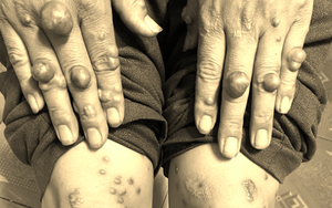 U cục mọc lổm nhổm 'đeo đẳng' người đàn ông suốt 8 năm, không ngờ 'thủ phạm' là mỡ máu 