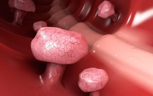 Khi nào u lành tính phát triển thành ung thư?