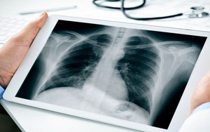  2 yếu tố gây tổn thương phổi quẩn quanh người Việt: Điều số 1 nhiều người 'thích mê'