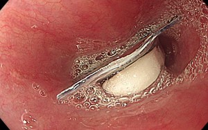 Nhiều trường hợp nuốt nhầm dị vật: Bác sĩ đưa ra lời cảnh báo