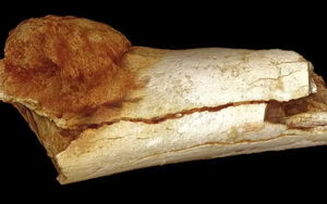 Ca ung thư cổ xưa nhất từng được ghi nhận ở loài người diễn ra từ lúc nào?