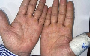 Xuất hiện lốm đốm trên da, người đàn ông đi khám phát hiện mắc ung thư vì dùng một thứ lâu năm