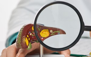 36 tuổi mắc ung thư gan, 'thủ phạm' là thứ quen mặt, nhiều người Việt mang trong người nhưng thờ ơ