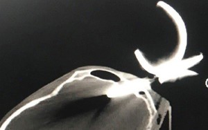 Cứu sống người đàn ông bị dị vật kim loại cắm vào hộp sọ