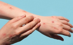 Số ca mắc đậu mùa khỉ ở Thái Lan tăng mạnh trong tháng 6