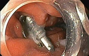 Cấp cứu thành công bé trai nuốt phải cây đinh vít nhọn