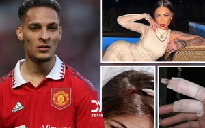 5 cáo buộc của bạn gái cũ đang đẩy sự nghiệp của Antony đến bờ vực