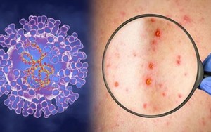 Cà Mau ghi nhận trường hợp bệnh đậu mùa khỉ đầu tiên