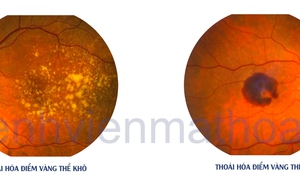 Thoái hóa điểm vàng - những điều cần biết