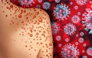 Na Uy, Hà Lan sẵn sàng ứng phó với bệnh đậu mùa khỉ