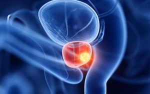 Đột phá mới giúp cải thiện đáng kể ung thư tuyến tiền liệt giai đoạn đầu