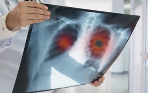 Tỷ lệ mắc ung thư tại Pháp ở top đầu thế giới