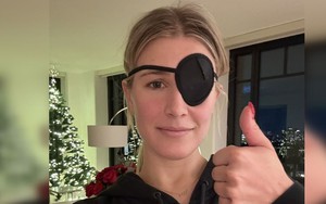 Hơn 3000 ca chấn thương mắt vì chơi pickleball, bác sĩ Mỹ khuyến cáo dùng kính bảo hộ vì quả bóng bay quá nhanh